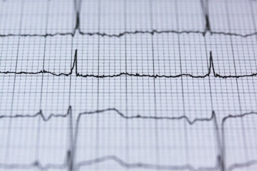 EKG chart